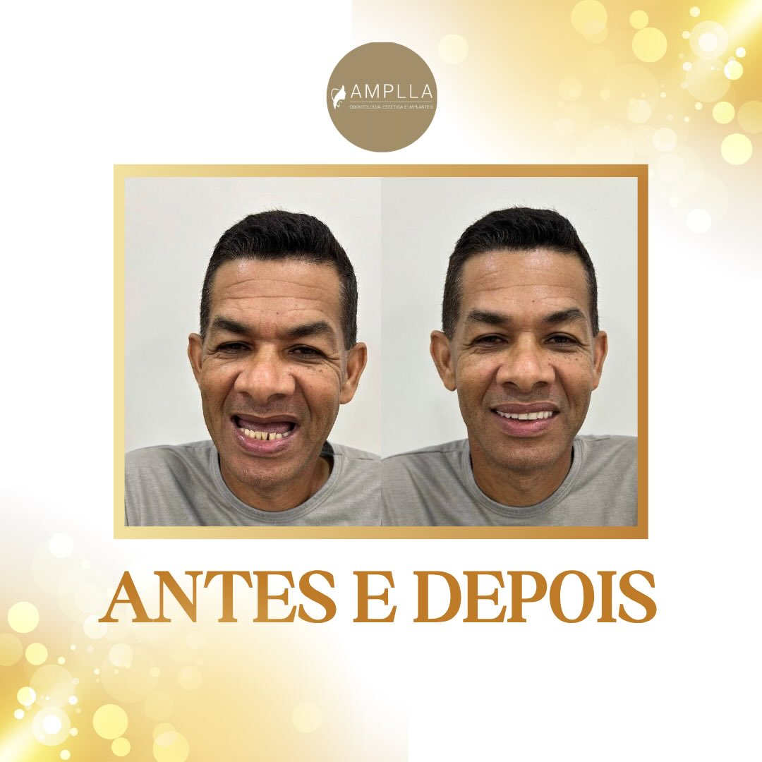 Antes e depois — caso 2 · Amplla Odontologia